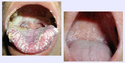 Corticosteroides orales ejemplos