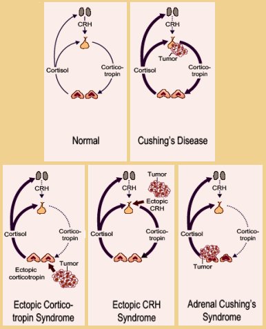 adenoma