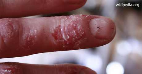 En que es parecida la psoriasis a los niños