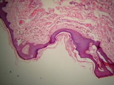 papiloma fibroepitelial benigno)