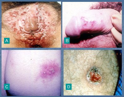 Patología infecciosa de la piel II: infecciones virales y parasitarias -  Medwave