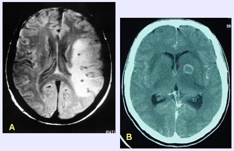 toxoplasmosis cerebral vih tratamiento