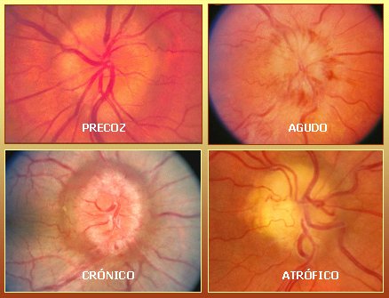 Compromiso ocular en enfermedades sistémicas I - Medwave