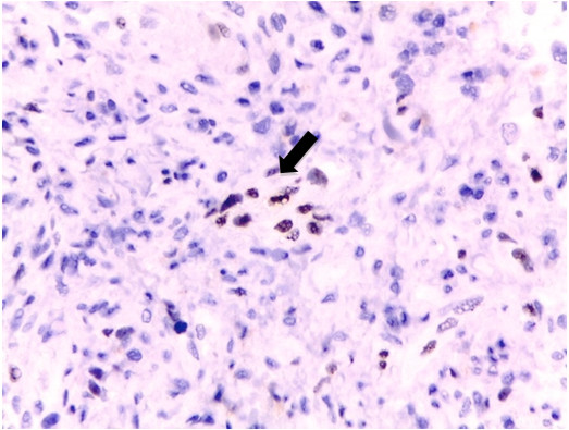 Diagnosis Of Elephantiasis Nostras Verrucosa As A Clinical 
