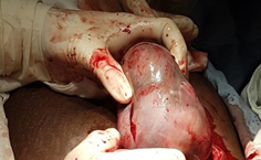 Embarazo ectópico abdominal secundario a perforación uterina por interrupción voluntaria del embarazo: presentación de caso
