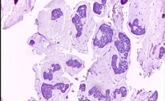 Carcinoma mucinoso de la mama: reporte de caso y revisión de la literatura