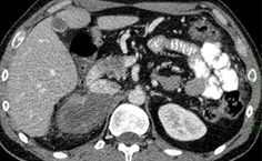 Quimioterapia paliativa tras progresión a la primera línea en el carcinoma suprarrenal metastásico: caso clínico y revisión de la literatura