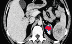 Sclerosing angiomatoid nodular transformation of the spleen: A case report