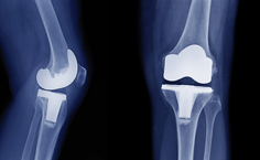 Impacto de la pandemia por COVID-19 en la incidencia de artroplastías de rodilla en Chile: estudio transversal basado en registro nacional