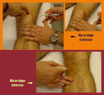 artroza simptomelor și tratamentului degetului de la picior
