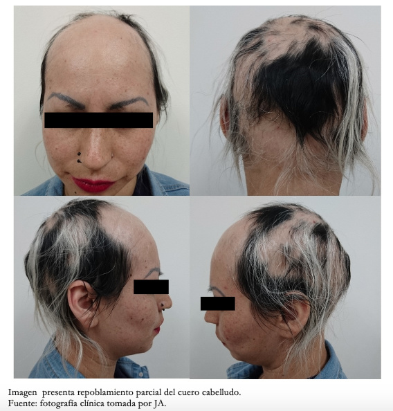 Reporte de manejo exitoso con y alopecia areata Medwave