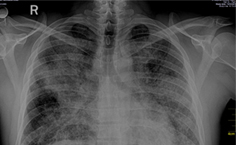Proteinosis alveolar pulmonar: a propósito de un caso 