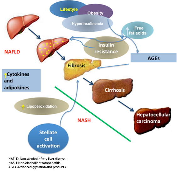 Liver steatosis and nonalcoholic steatohepatitis: from pathogenesis to ...