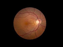 Anti-factor del crecimiento vascular endotelial (anti-VEGF) comparado con fotocoagulación láser para el tratamiento de la retinopatía del prematuro tipo 1