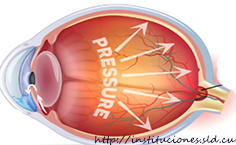 ¿Es mejor la trabeculectomía modificada con dispositivo o la cirugía clásica para el manejo del glaucoma?