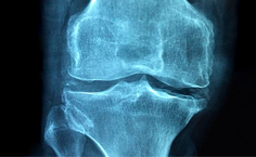 ¿Es la diacereína una alternativa para el tratamiento de la artrosis?