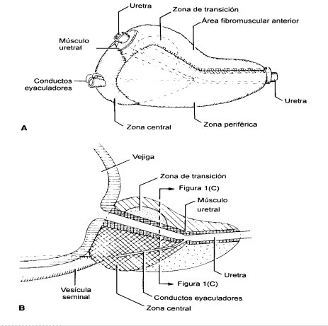 prostata con adenoma mediano)