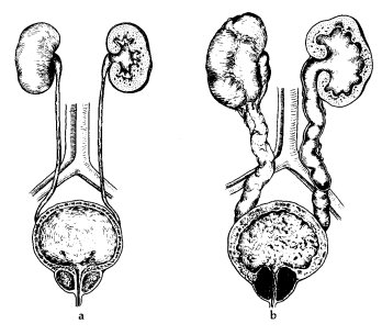 adenoma de prostata grado 2)