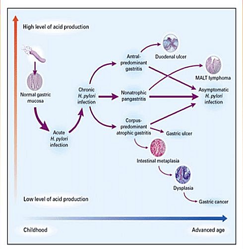 Infección por <i>Helicobacter pylori</i> - Medwave